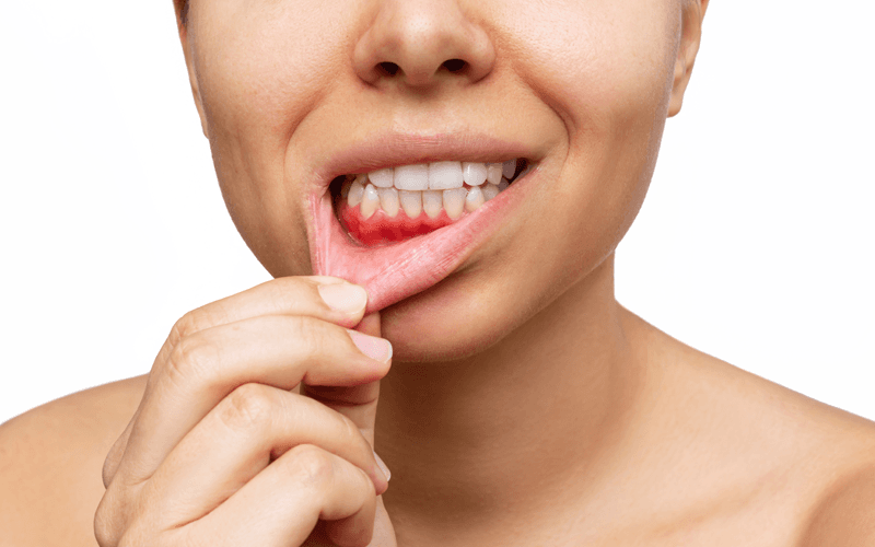 Signs of Gum Disease