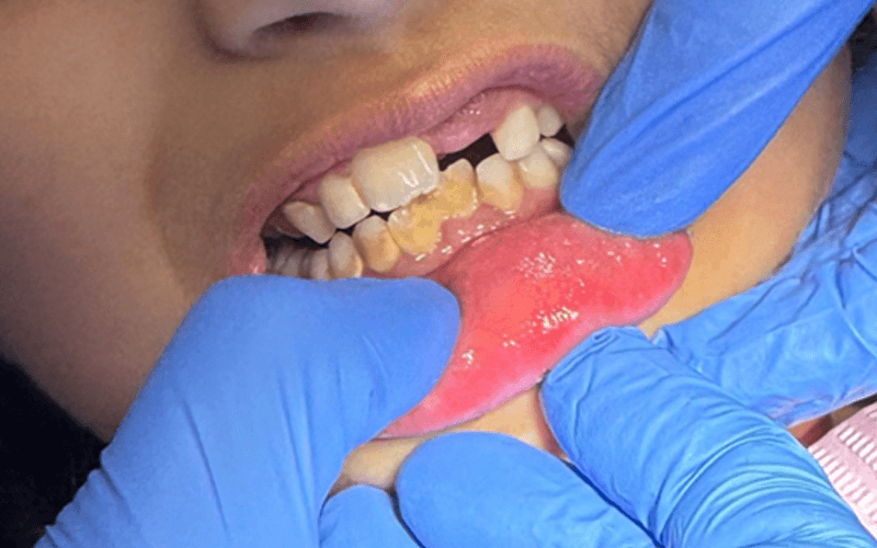 A dental professional examining the teeth and gums
