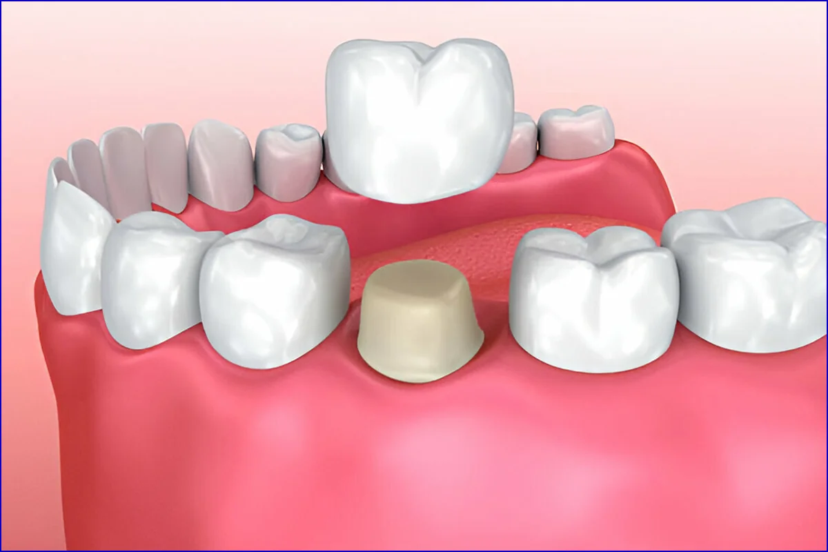 Crown & Bridge treatment visual