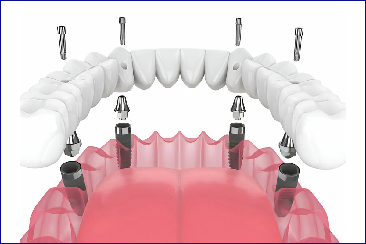 Dental Implants treatment photo 3