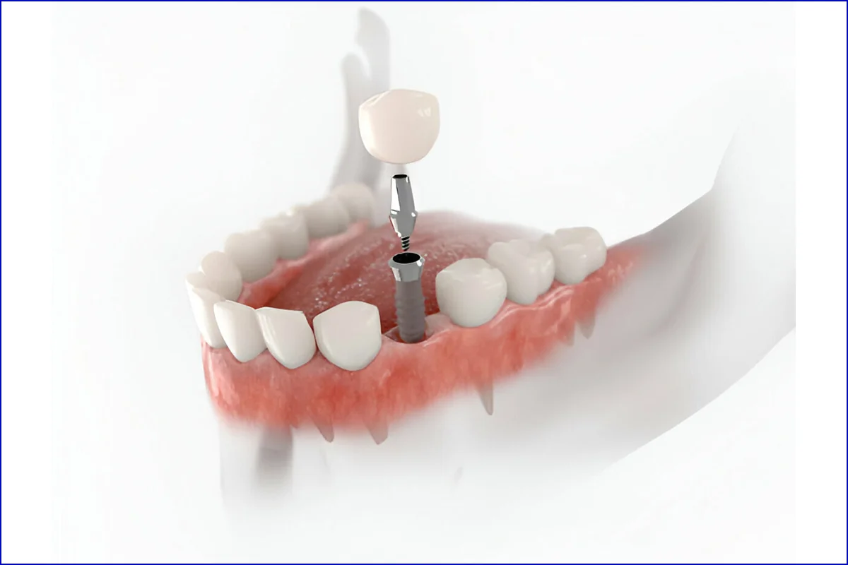 Dental Implants treatment photo 2