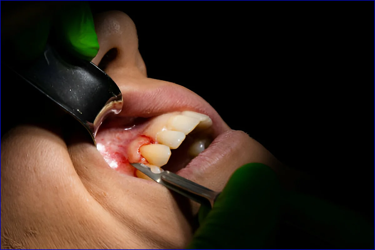 Periodontal (Gum) Surgery treatment photo 3