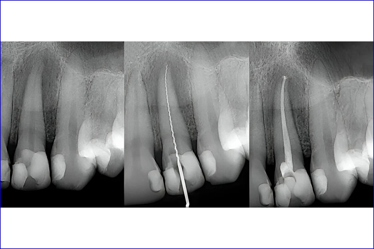 Root Canal Treatment treatment photo 3