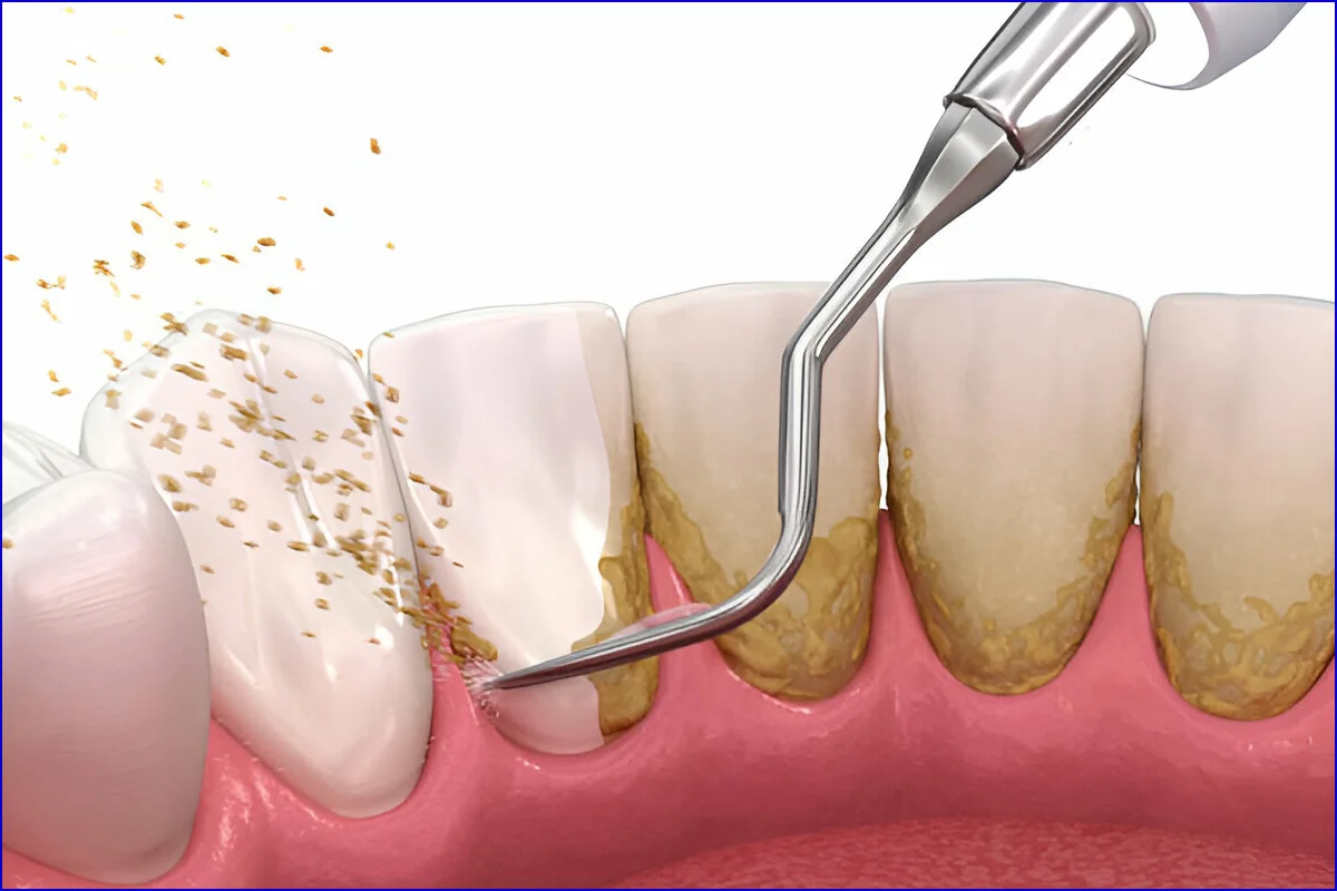 Scaling & Polishing treatment visual