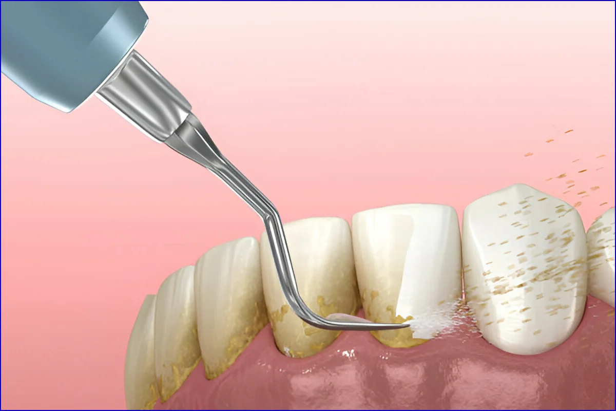 Scaling & Polishing treatment photo 2