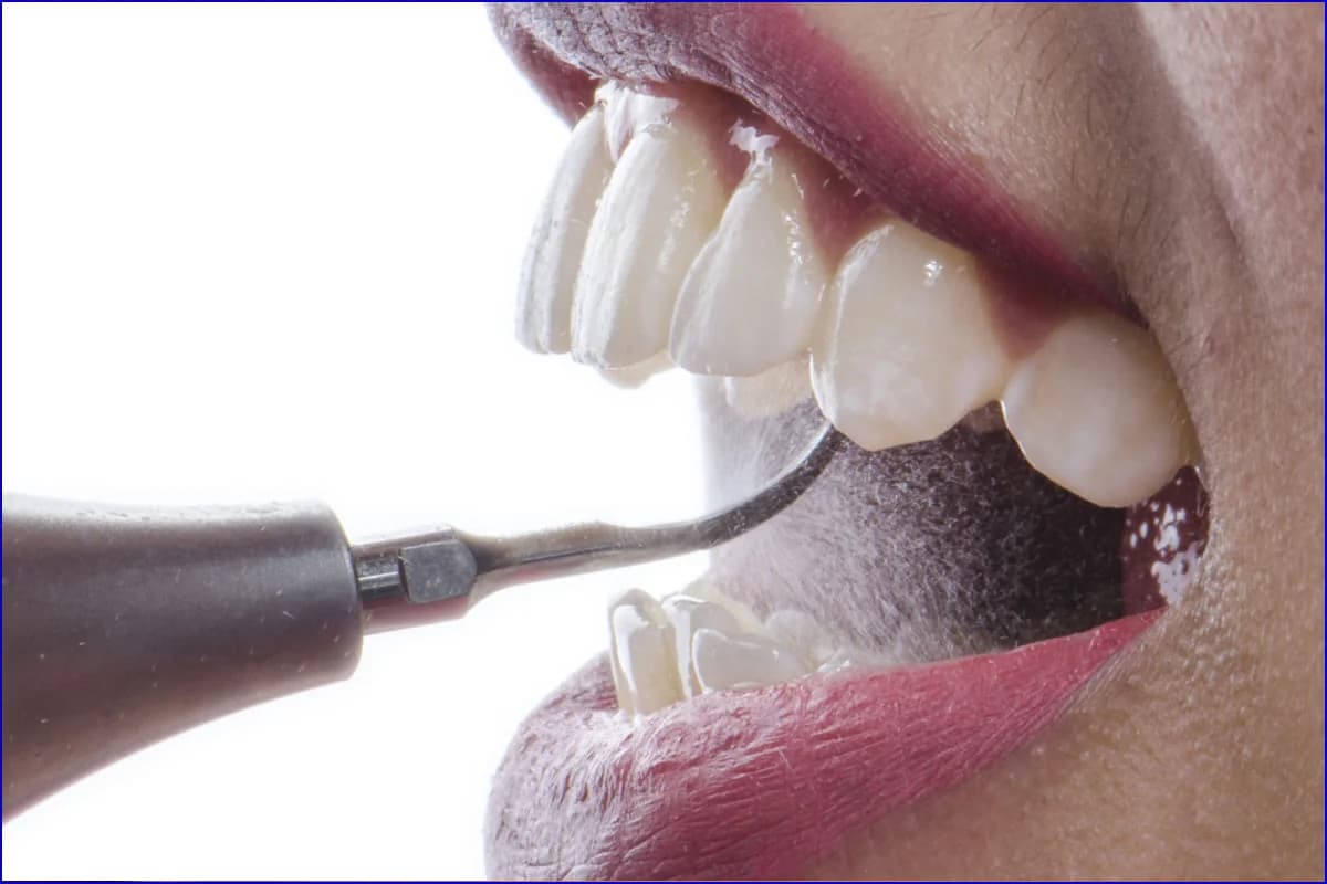 Scaling & Polishing treatment photo 3