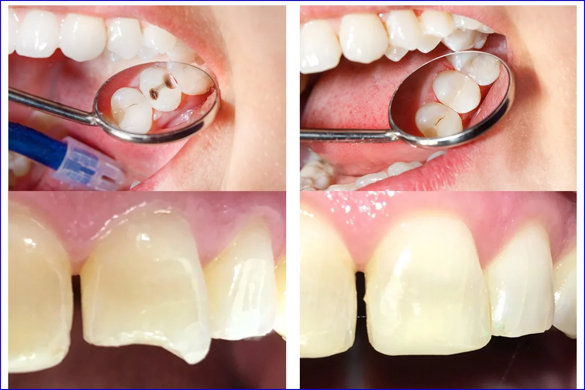 Tooth-coloured Fillings treatment photo 3