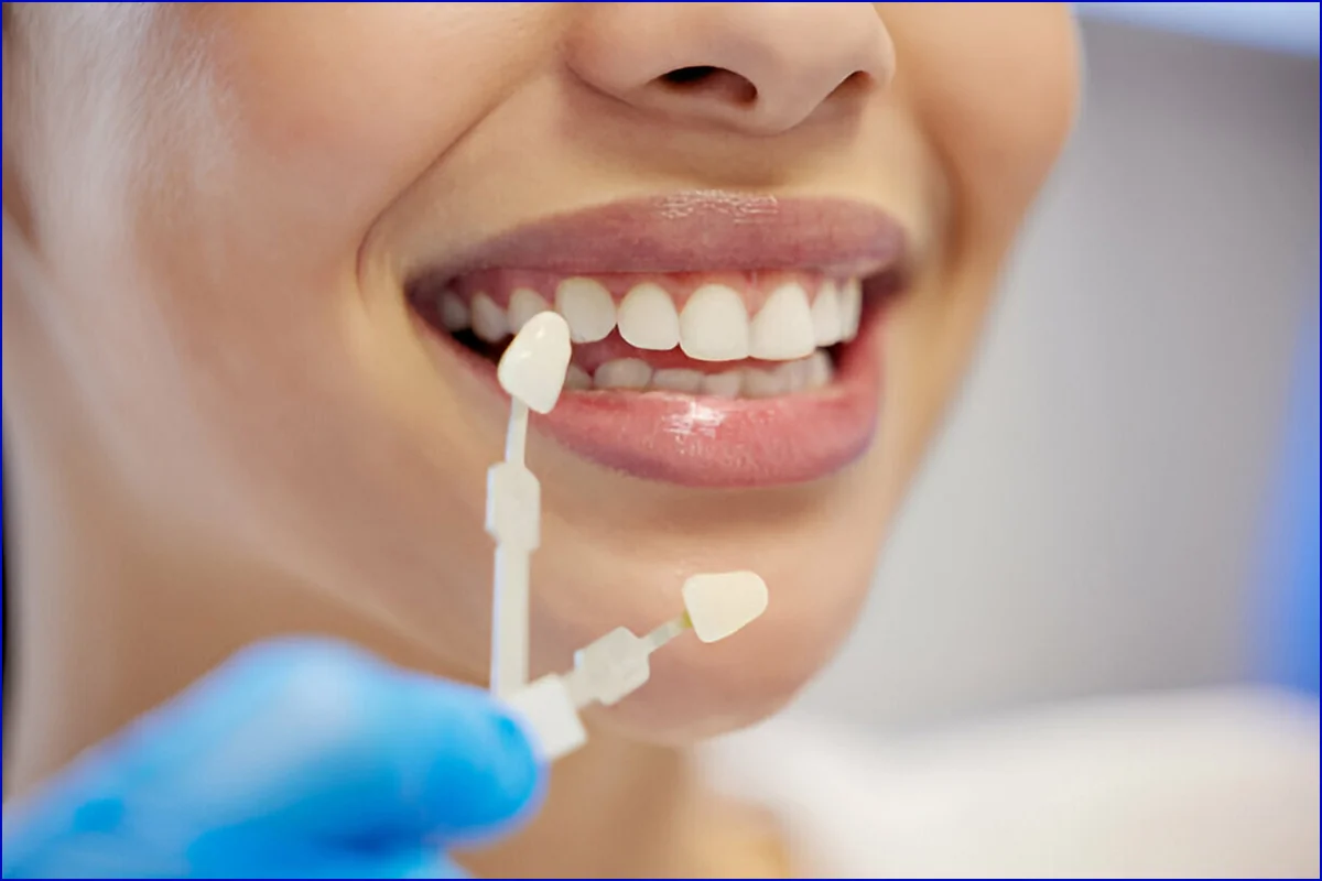 Veneers treatment photo 2
