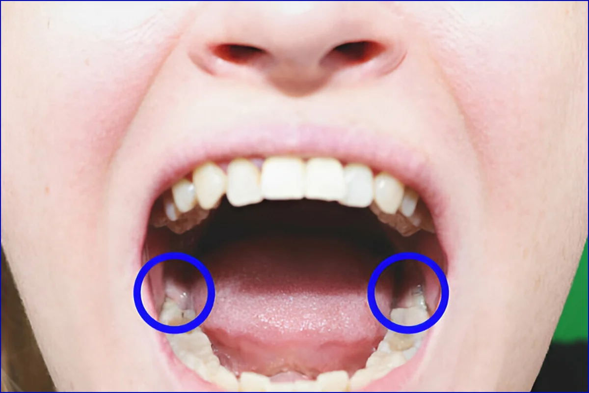 Wisdom Tooth Surgery treatment photo 3