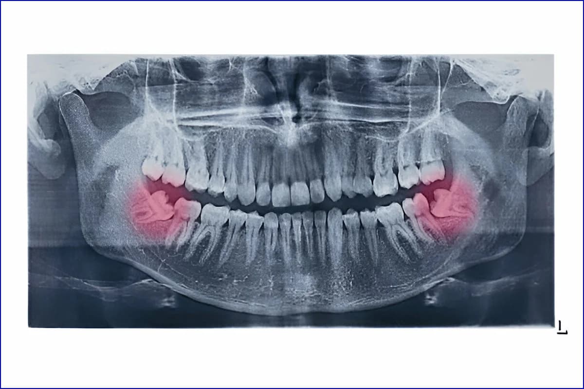 Wisdom Tooth Surgery treatment photo 2
