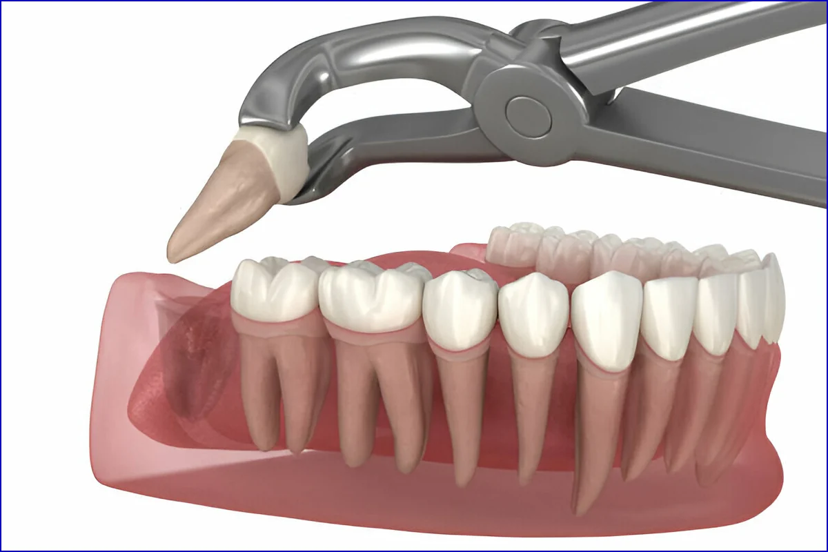 Wisdom Tooth Surgery treatment visual